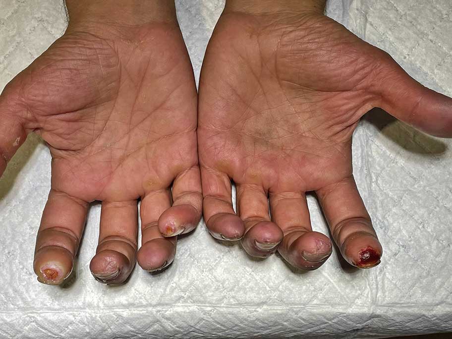 Finger ulcerations