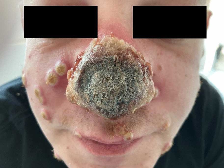 Nasal necrosis