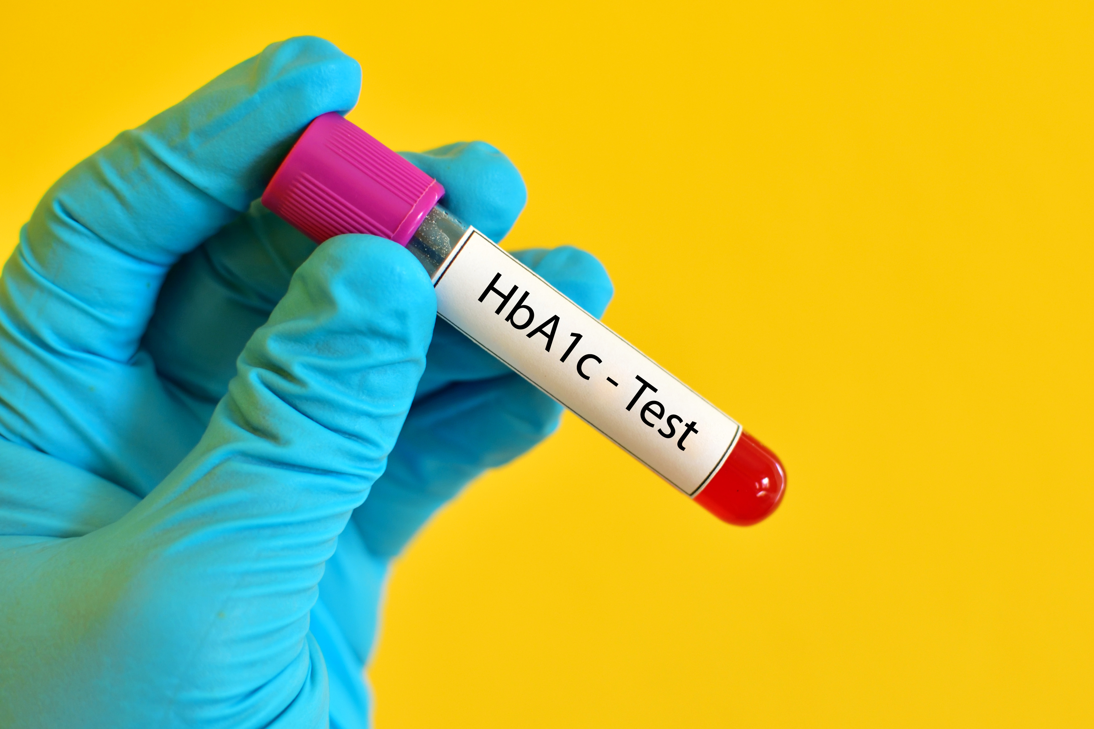 Test tube with blood for HbA1c test