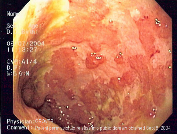 Ulcerative colitis seen on endoscopy