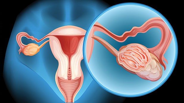 Diagram showing demale reproductive organs highlighting an ovary