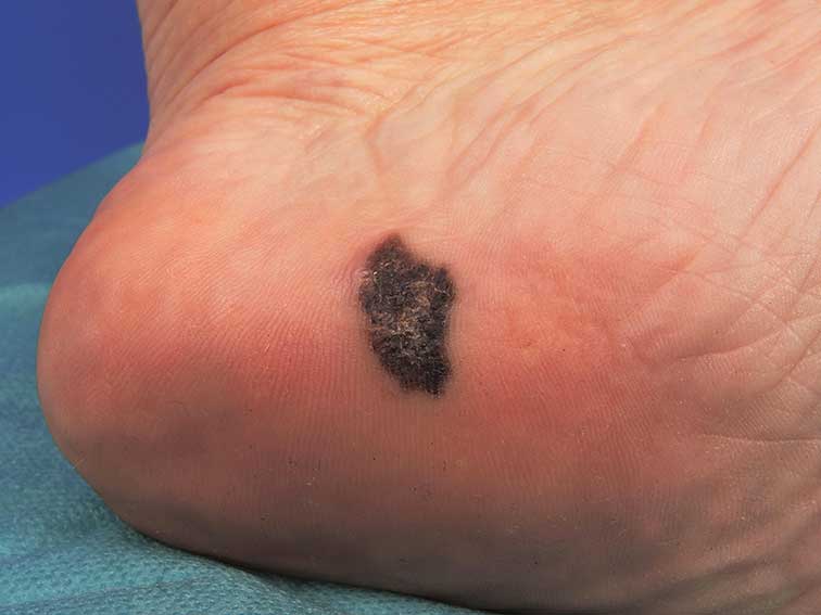 acral lentiginous melanoma on foot