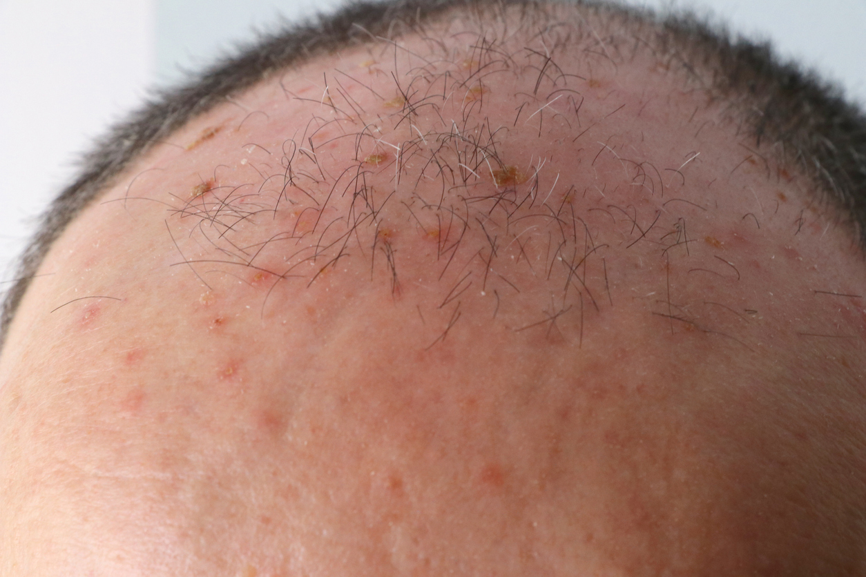 man's scalp with actinic keratoses