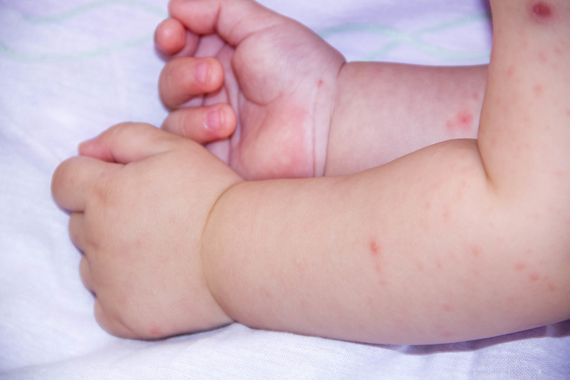 baby's arms with atopic dermatitis