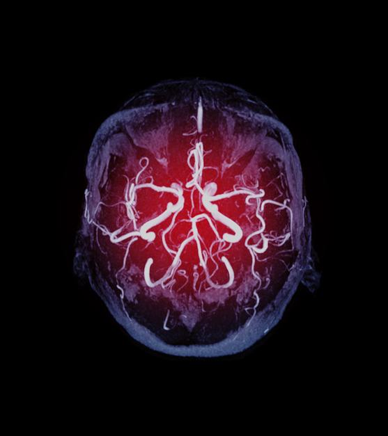 Brain image showing blood vessels