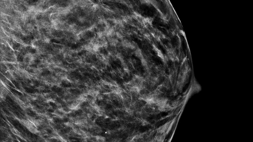3-D breast scan image
