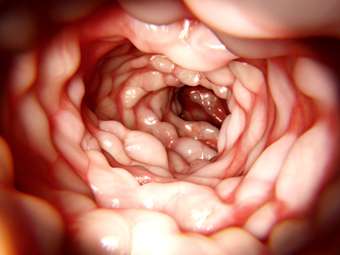 Endoscopic view in Crohn's patient