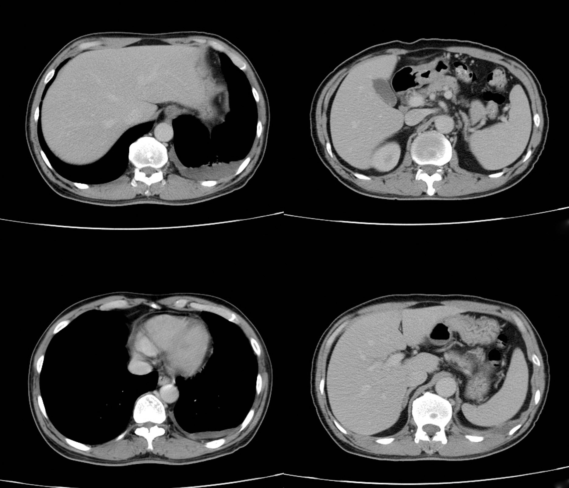 Lung cancer CT