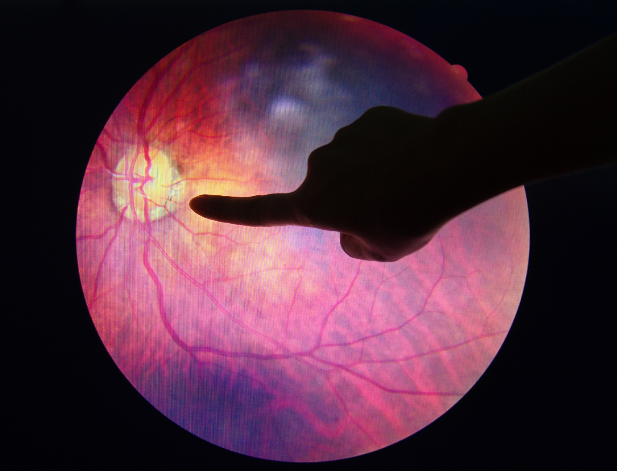 retina with signs of diabetic retinopathy