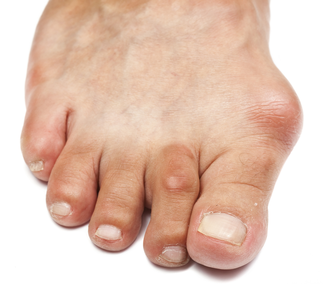 gouty foot