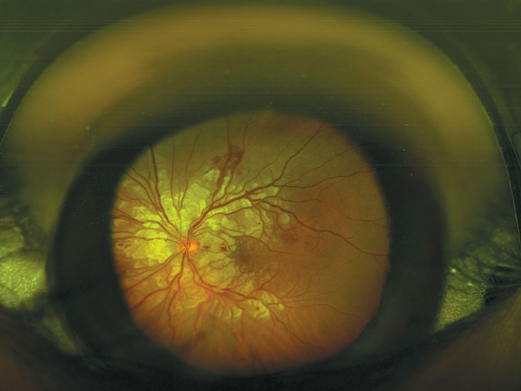 Purtscher's retinopathy