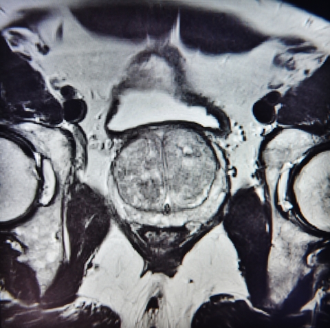 MRI of prostate