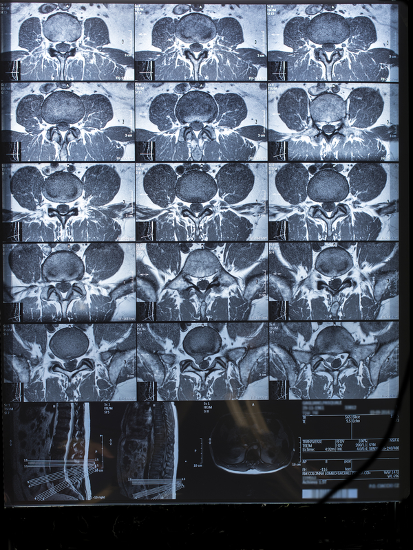 MRI scans lumbar spine