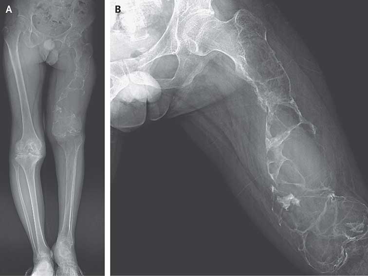X-ray of femur
