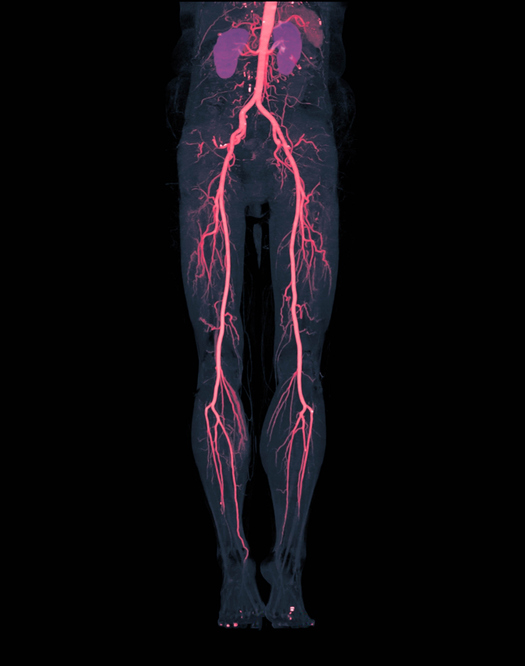 arteries of the legs