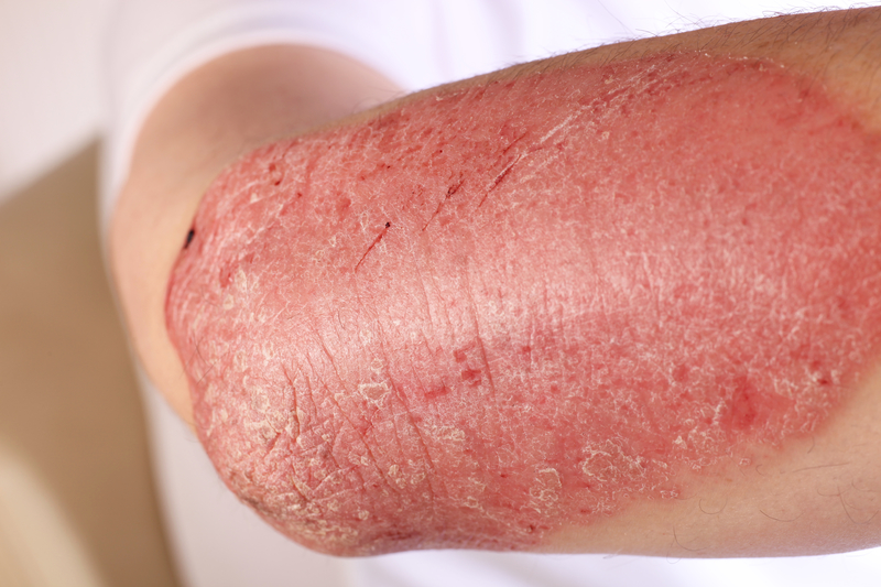plaque psoriasis on an arm