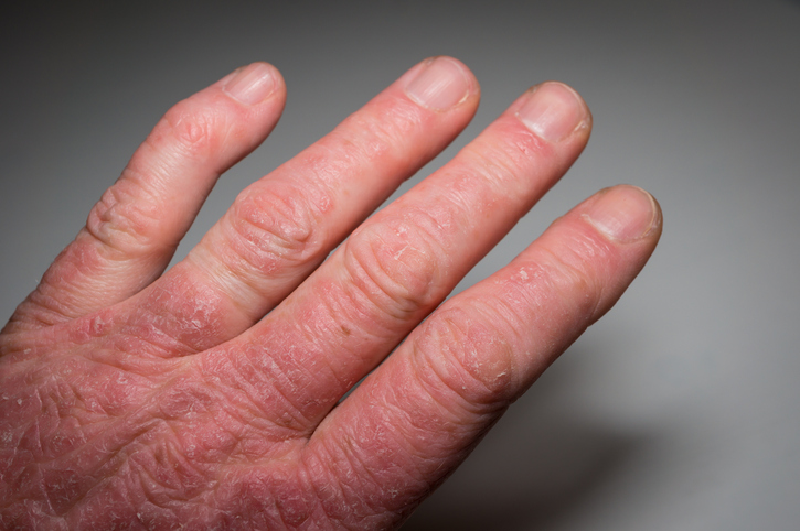 Hand of a patient with psoriasis and psoriatic arthritis