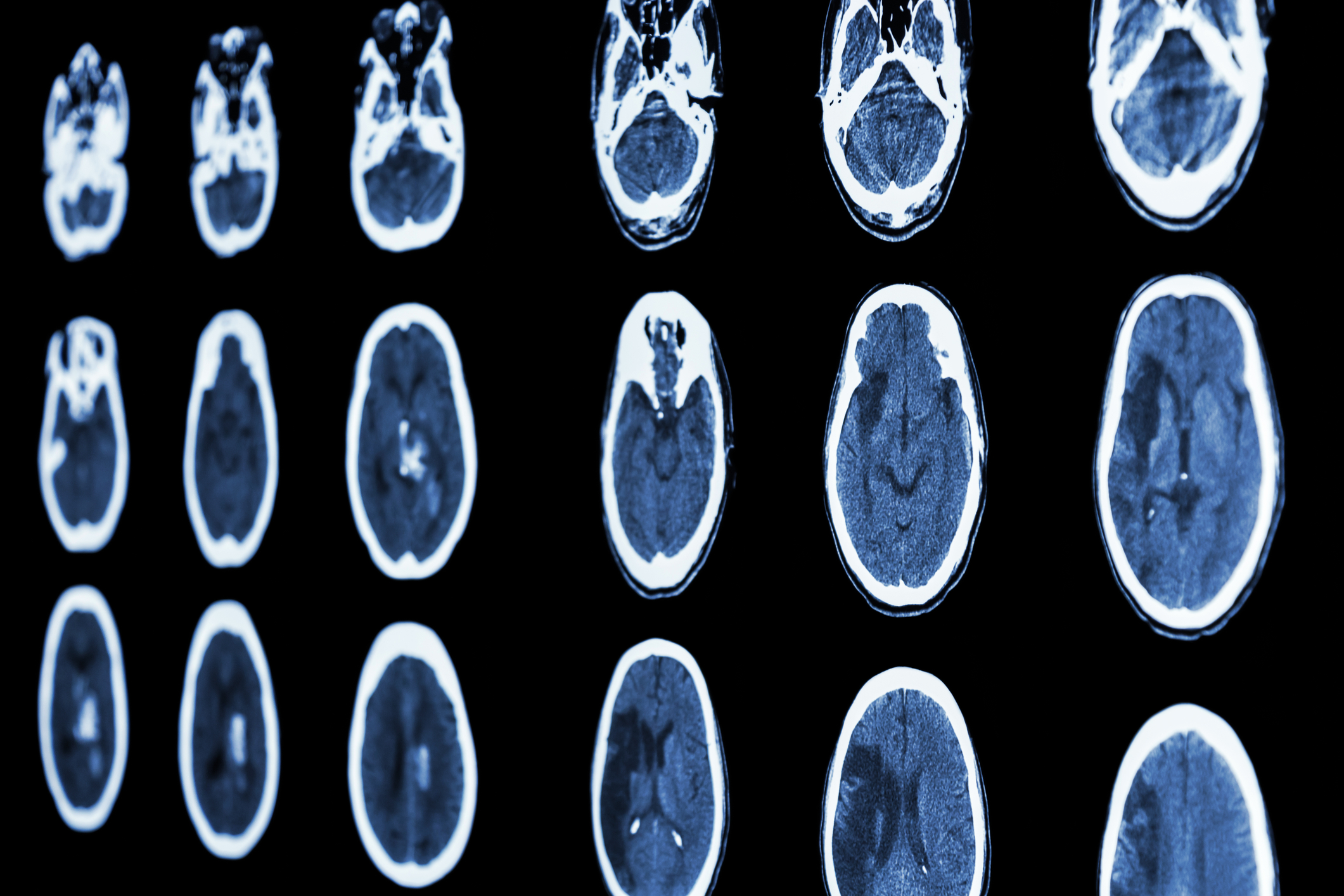 stroke - brain MRI