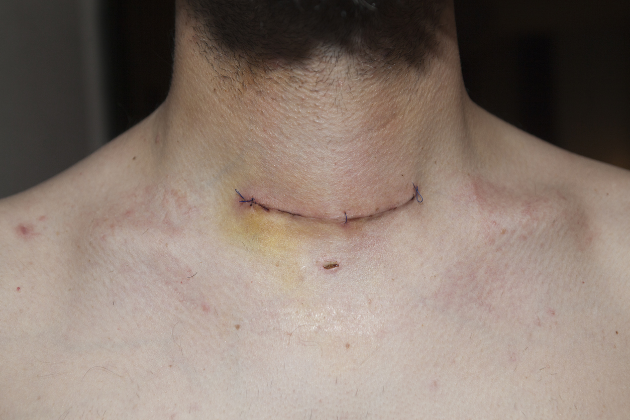 Man with thyroidectomy scar