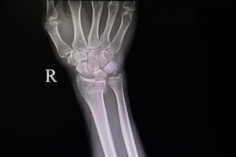 X-ray of fractured wrist